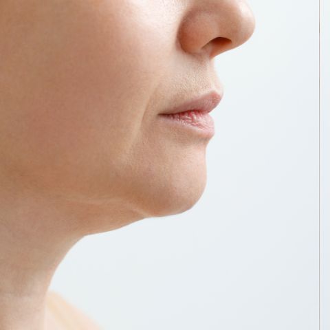before photo showing a woman's non-surgical cosmetic treatment on face and jowl